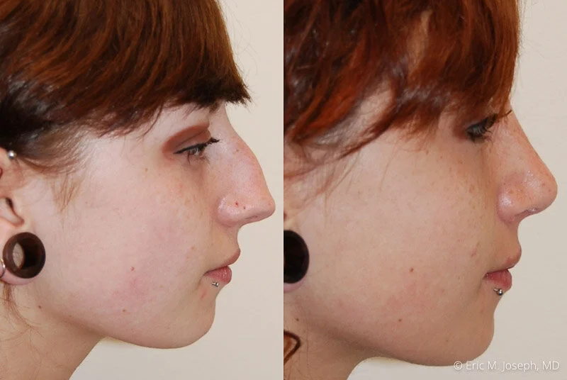 Rhinoplasty-0097.jpg