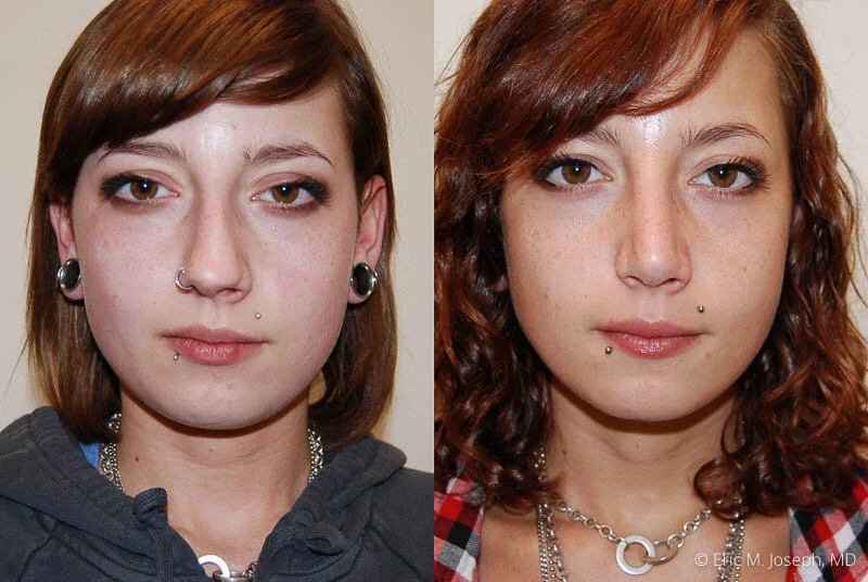 Rhinoplasty-0098.jpg