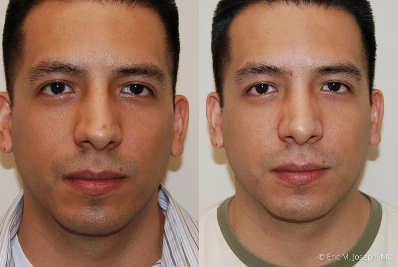 Rhinoplasty-0099.jpg