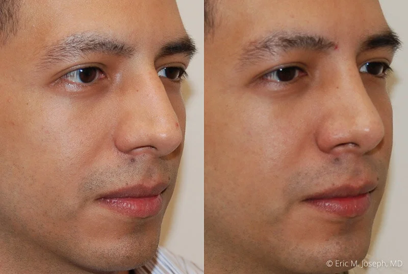 Rhinoplasty-0100.jpg
