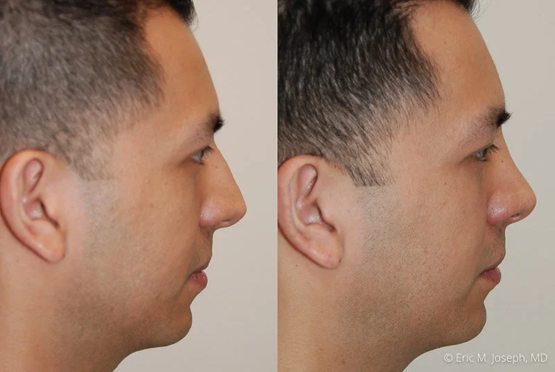 Rhinoplasty-0101.jpg