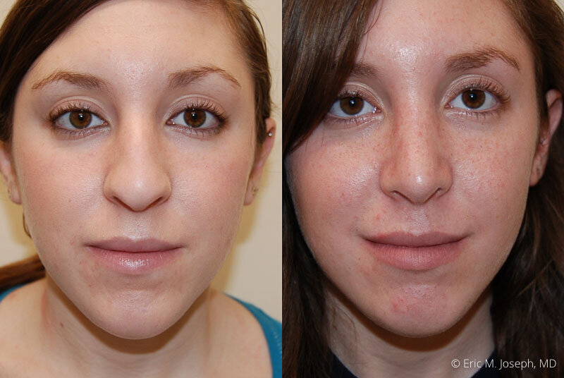 Rhinoplasty-0104.jpg