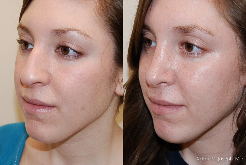 Rhinoplasty-0105.jpg