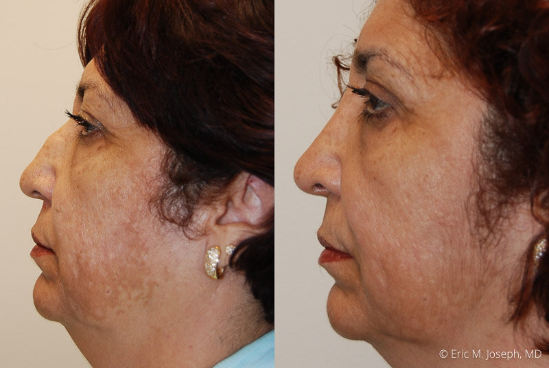 Rhinoplasty-0106.jpg