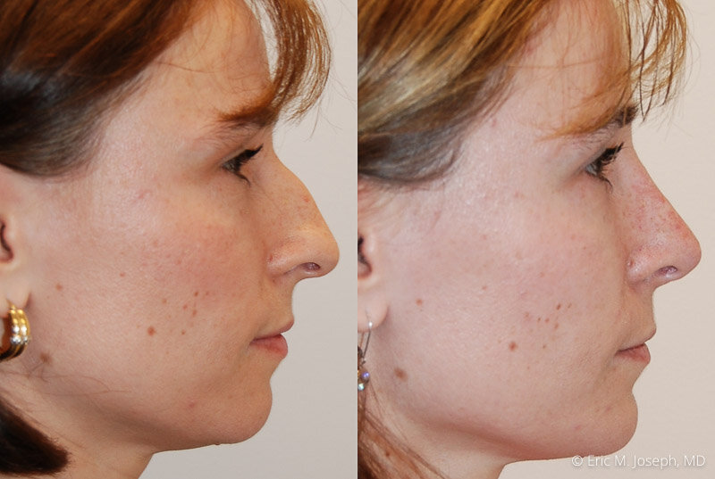 Rhinoplasty-0109.jpg