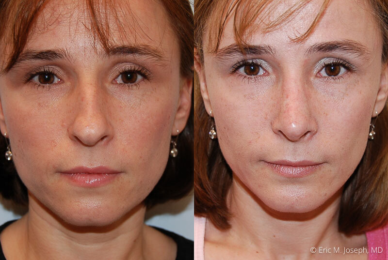 Rhinoplasty-0110.jpg