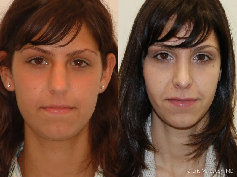 Rhinoplasty-0112.jpg