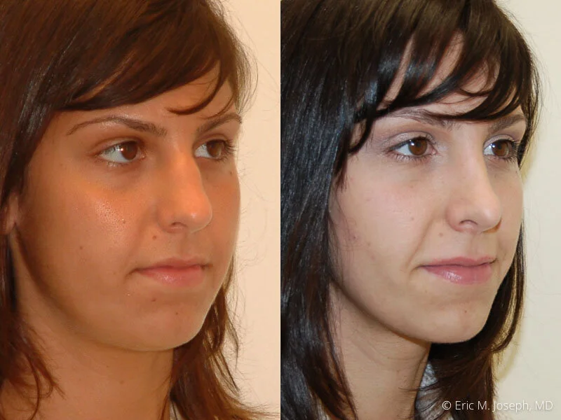 Rhinoplasty-0113.jpg