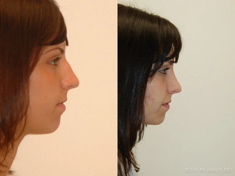 Rhinoplasty-0114.jpg
