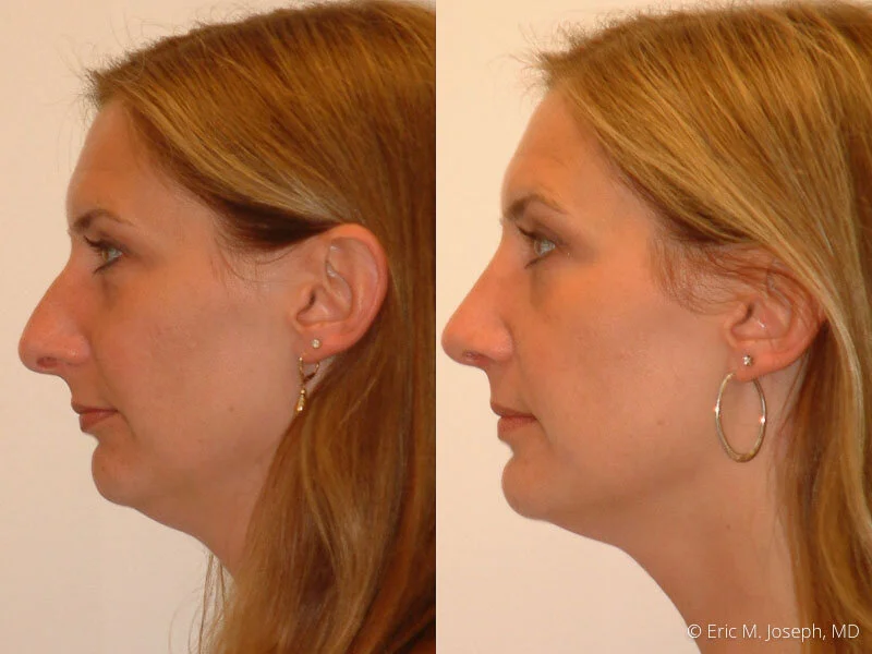 Rhinoplasty-0117.jpg