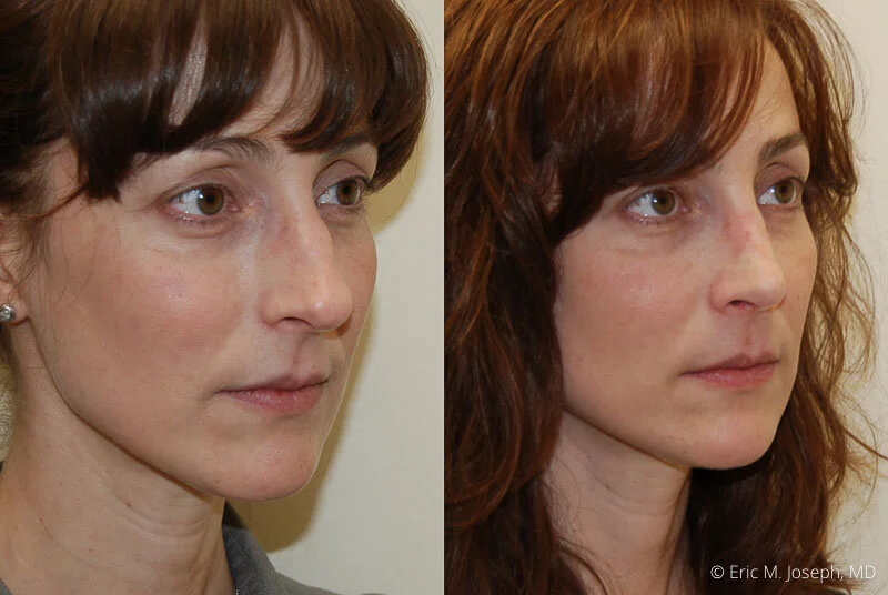 Rhinoplasty-0119.jpg