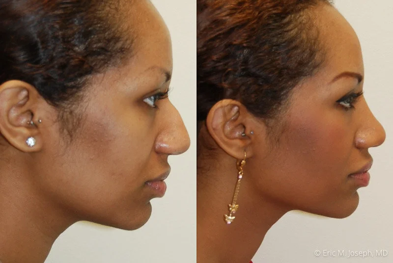 Rhinoplasty-0122.jpg