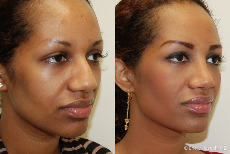 Rhinoplasty-0123.jpg