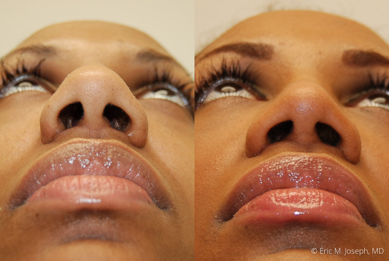 Rhinoplasty-0125.jpg