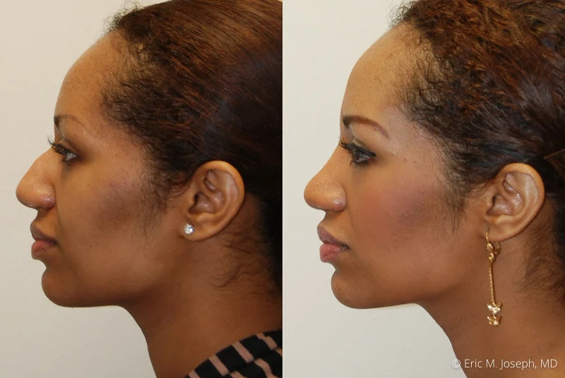 Rhinoplasty-0126.jpg