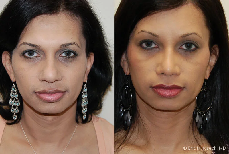 Rhinoplasty-0127.jpg