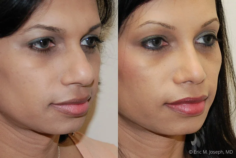 Rhinoplasty-0128.jpg