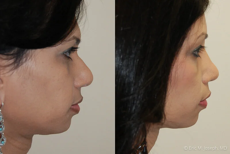 Rhinoplasty-0129.jpg