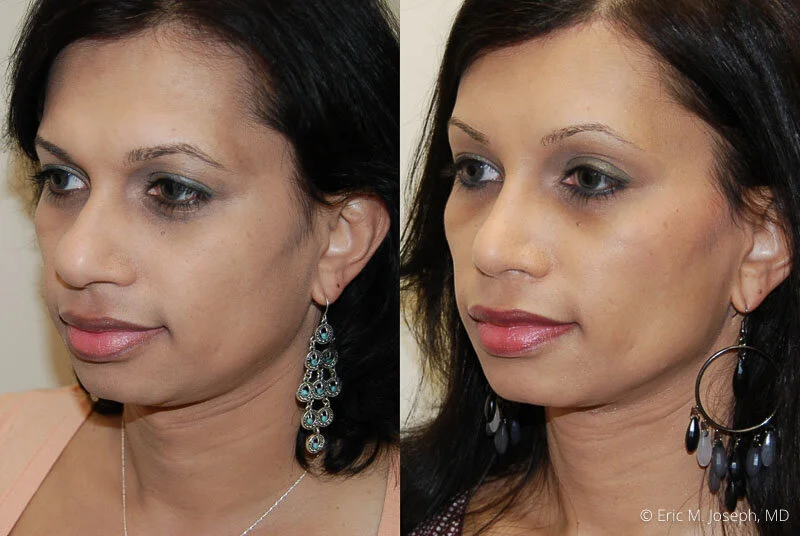 Rhinoplasty-0130.jpg