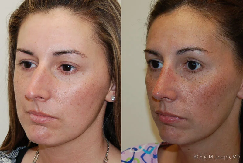 Rhinoplasty-0133.jpg