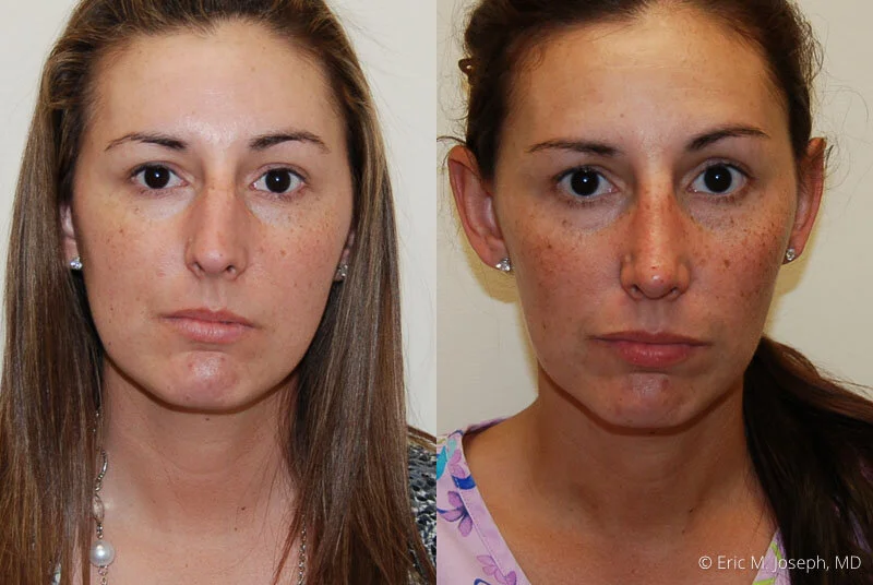 Rhinoplasty-0134.jpg