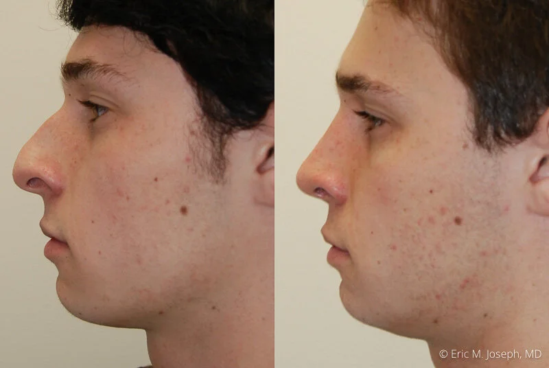Rhinoplasty-0141.jpg