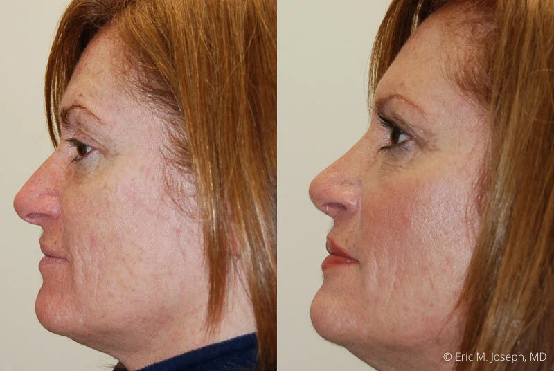 Rhinoplasty-0144.jpg