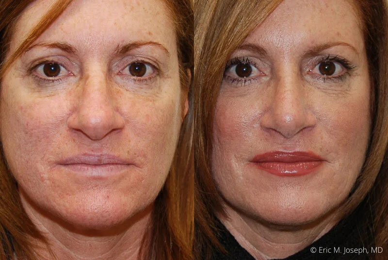 Rhinoplasty-0145.jpg