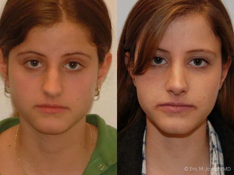 Rhinoplasty-0147.jpg
