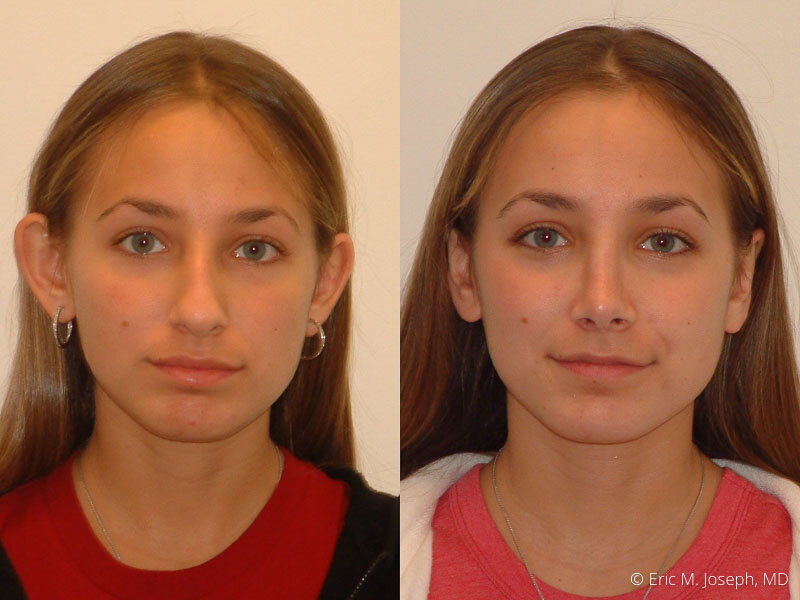 Rhinoplasty-0151.jpg