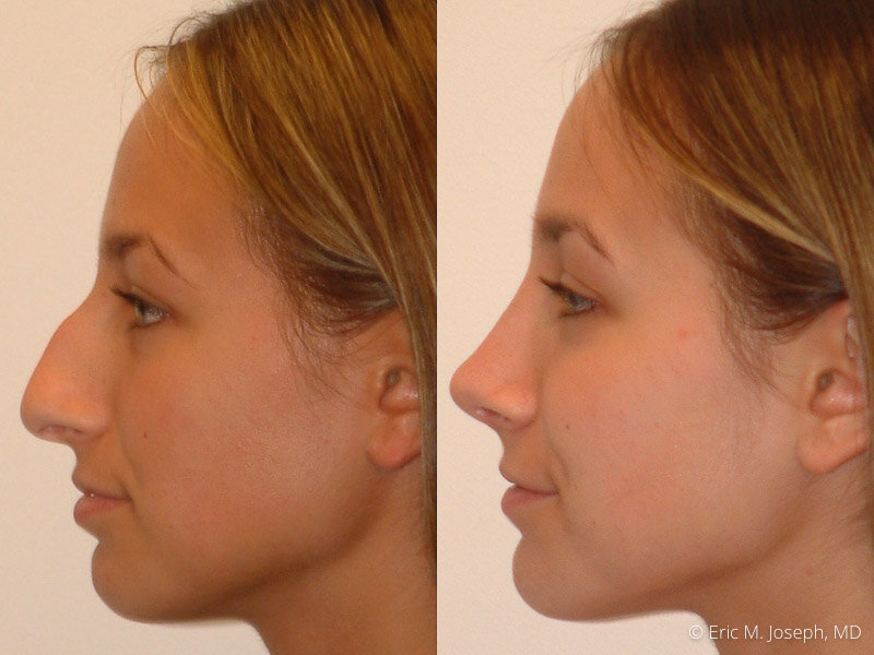 Rhinoplasty-0150.jpg