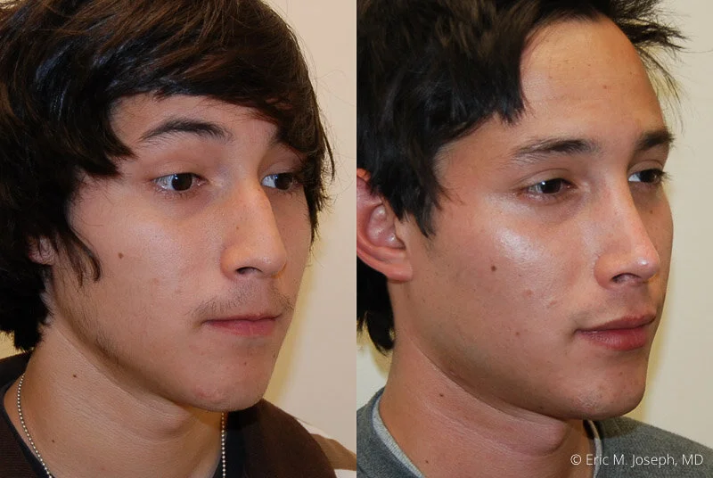 Rhinoplasty-0153.jpg