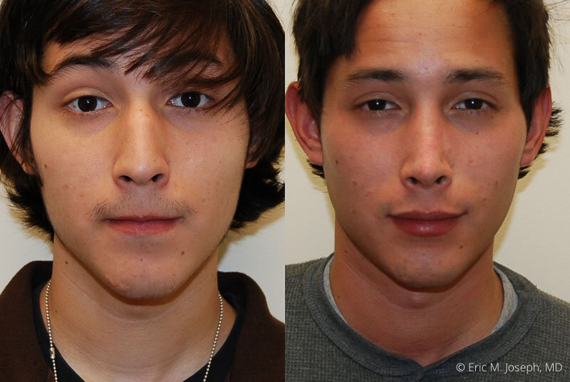 Rhinoplasty-0154.jpg