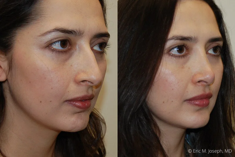 Rhinoplasty-0157.jpg