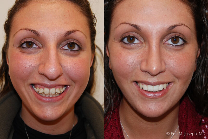 Rhinoplasty-0159.jpg