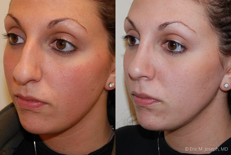 Rhinoplasty-0161.jpg