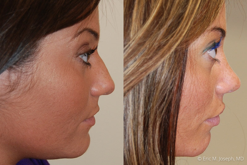 Rhinoplasty-0163.jpg