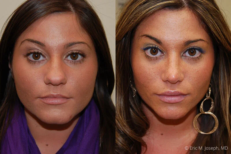Rhinoplasty-0162.jpg