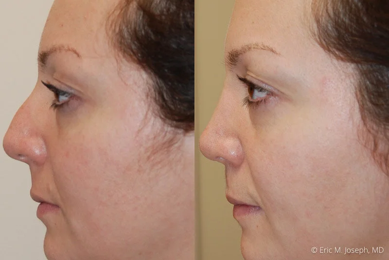 Rhinoplasty-0165.jpg
