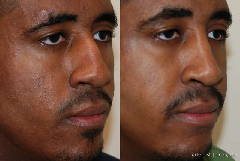 Rhinoplasty-0168.jpg