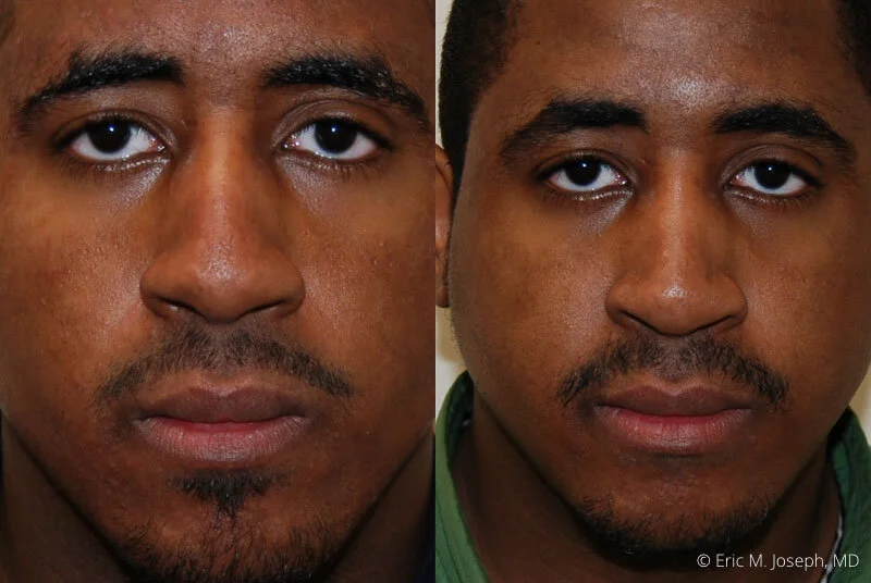 Rhinoplasty-0167.jpg