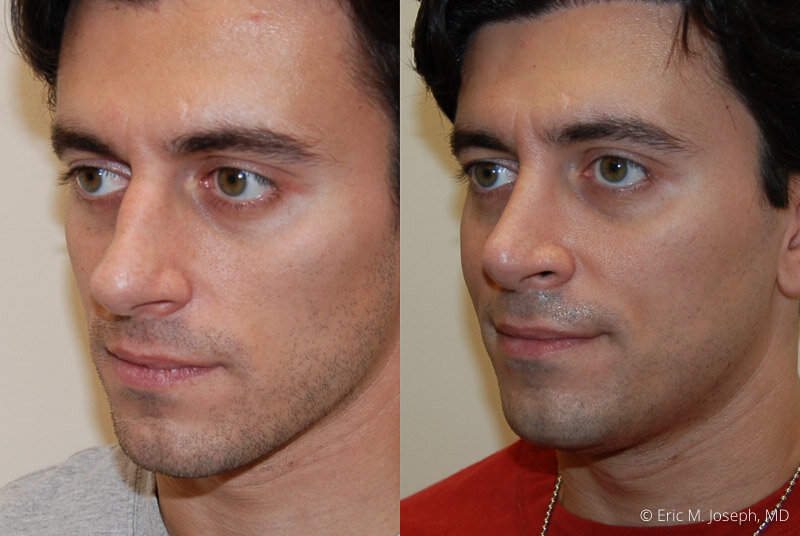 Rhinoplasty-0172.jpg