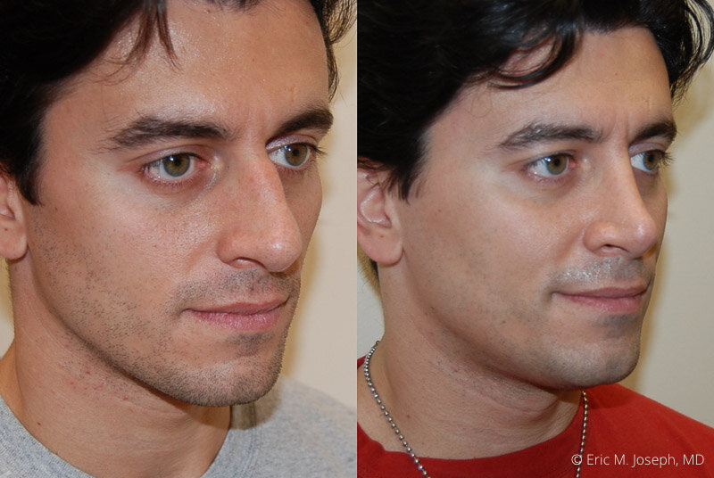 Rhinoplasty-0173.jpg
