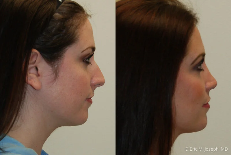 Rhinoplasty-0175.jpg