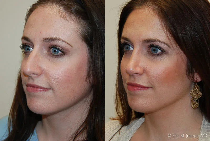 Rhinoplasty-0177.jpg