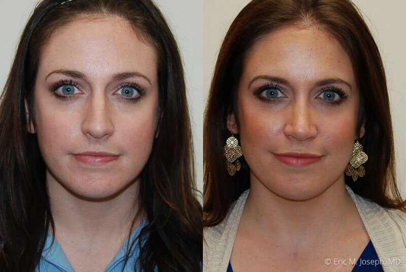 Rhinoplasty-0179.jpg