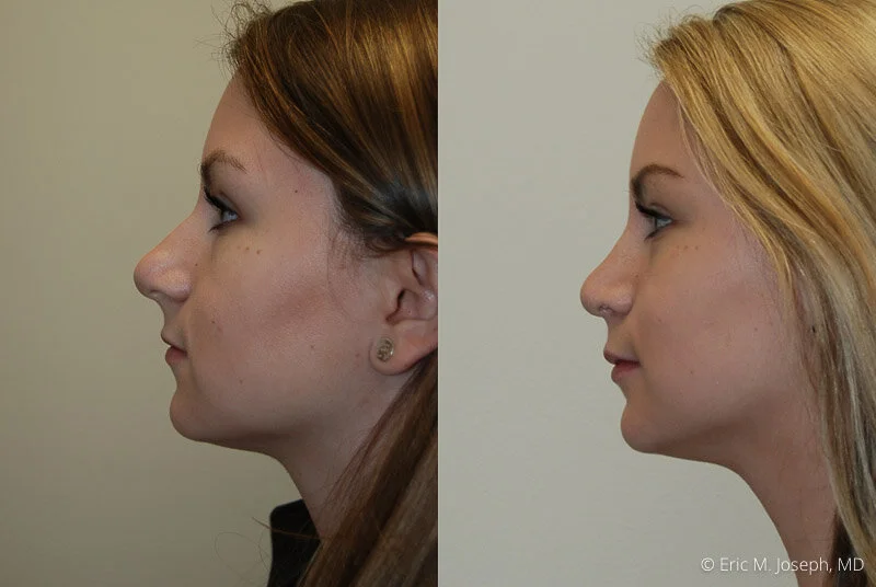 Rhinoplasty-0181.jpg
