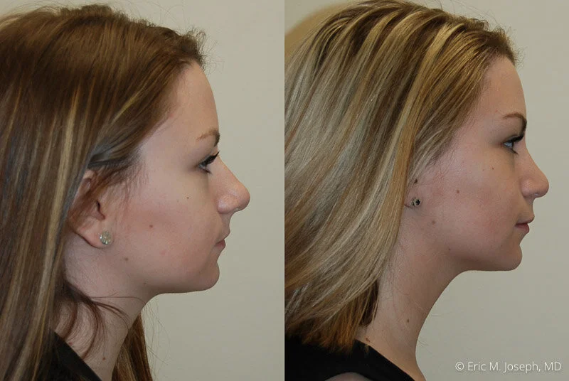 Rhinoplasty-0180.jpg