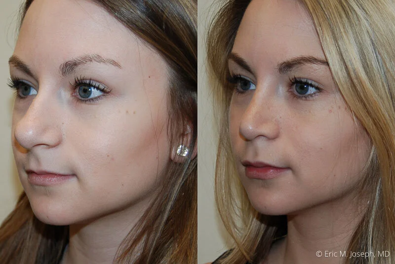 Rhinoplasty-0182.jpg