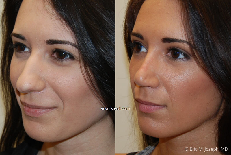 Rhinoplasty-0187.jpg